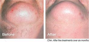 hair-removal before & after