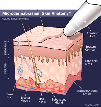 microdermabrasion skin anatomy