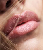 juvederm restylane