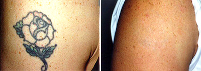 laser tattoo removal before & after