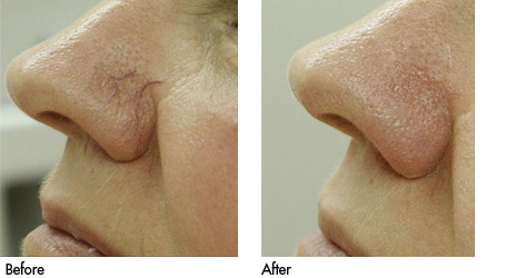 laser therapy for veins on face before and after